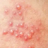 پاک سازی ریشه ای  زگیل و تبخال تناسلی