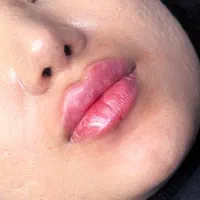 فیلر ،بوتاکس ، مزو ، مزوژل مدل|خدمات آرایشگری و زیبایی|اصفهان, سعادت‌آباد|دیوار