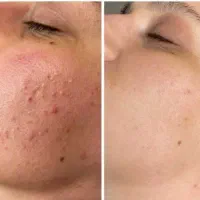 سلوشن پوست ازبین برنده تمامی مشکلات دوستی