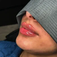 تخفیف لیزر و تزریقات ژل ، بوتاکس و مزو|خدمات آرایشگری و زیبایی|تهران, مهران (سیدخندان)|دیوار