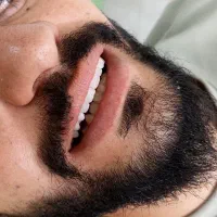 ساخت انواع دندان مصنوعی کامل و تکی (هردوفک 8تومن)