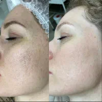 کربن تراپی (پیلینگ هالیودی)در مطب پزشک|خدمات آرایشگری و زیبایی|قم, بلوار امین و ساحلی|دیوار