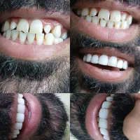 کامپوزیت دندان و ترمیم