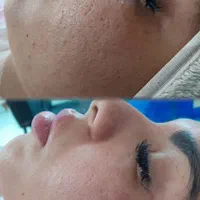 ارائه خدمات فیشال  و پاکسازی صورت با بهترین متریال|خدمات آرایشگری و زیبایی|مشهد, عبادی|دیوار