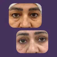 تزریق فیلر و بوتاکس و پی آر پی و مزونیدلینگ