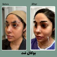 لیپو ساکشن غبغب و بوکال فت ( + شرایط )|خدمات آرایشگری و زیبایی|مشهد, گلبرگ شمالی|دیوار
