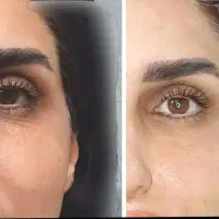لیزر کل بدن ۴۴۰ مطب مسکن فیلر بوتاکس مزو|خدمات زیبایی و سلامت|کرمانشاه, |دیوار