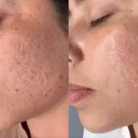 مدل رایگان برای پوست جوش دار و اسکار و لک|خدمات آرایشگری و زیبایی|رشت, گلباغ نماز|دیوار