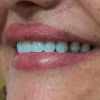 دندانسازی ساخت دندان مصنوعی|خدمات آرایشگری و زیبایی|خرمآباد, |دیوار