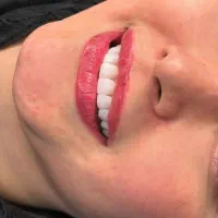 کامپوزیت.لمینت .ایمپلنت