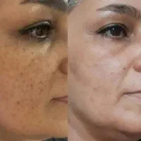 مزونیدلینگ ولیزر زائده های گوشتی وخال آقا و خانم