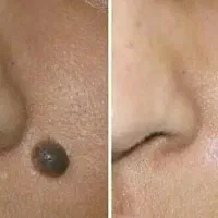 برداشت خال و لک و چربی و ملیا