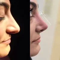 جراحی بینی و پلک، لیفت ابرو و شقیقه، لیفت صورت|خدمات آرایشگری و زیبایی|خوی, |دیوار