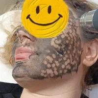 رفع تاتوروشن‌سازی زیربغل کربن تراپی مطب دکترموسوی|خدمات آرایشگری و زیبایی|تهران, فردوس|دیوار