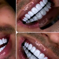 کاشت دندان 12 ( کشیدن رایگان)|خدمات زیبایی و سلامت|کرمانشاه, |دیوار