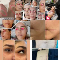 آموزش مزو نیدلینگ +تکنیک پوست کره ای+کاموفلاژ بدن|خدمات آموزشی|مشهد, هنرستان|دیوار