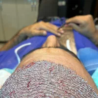 کاشت مو تضمینی با روش fit|خدمات آرایشگری و زیبایی|تبریز, |دیوار