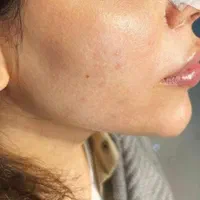 ژل لب فیلربینی مزو بوتاکس ژل بدن  ۳۹۹ آموزش پزشک|خدمات آرایشگری و زیبایی|فردیس, |دیوار