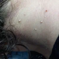 برداشت منگوله پوستی و میلیا