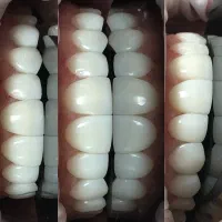 (زیبایی) ونییر کامپوزیت و لمینیت، بلیچینگ|خدمات آرایشگری و زیبایی|رشت, گلسار|دیوار