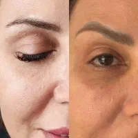 پاک کردن تاتو با لیزر پیکوسکند