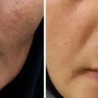 کرم بیوممتیک ضد لک و ضد جوش« تضمینی»