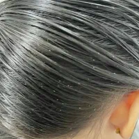 رشک وشپش|آرایشی، بهداشتی، درمانی|تاکستان, |دیوار