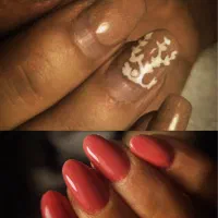 کاشت ناخون رشت