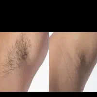 لیزر موهای زائد +کربن تراپی پلینگ