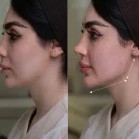 بوتاکس خالبرداری فیلر پی ارپی رفع ماه گرفتگی ضد لک|خدمات زیبایی و سلامت|مشهد, هفت تیر (حافظ)|دیوار