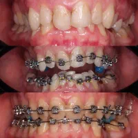ارتودنسی فقط ۱۳ میلیون اقساط بدون چک.|خدمات زیبایی و سلامت|تهران, جردن|دیوار