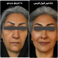 تزریق چربی صورت با ماندگاری ۱۰ ساله - دکتر واحدی|خدمات آرایشگری و زیبایی|قزوین, |دیوار