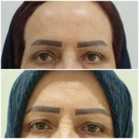 بوتاکس|خدمات آرایشگری و زیبایی|سنقر, |دیوار