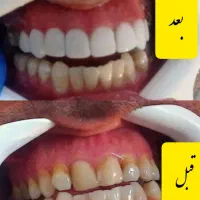 تخفیف ویژه پاییزه کامپوزیت دندان در درمانگاه|خدمات آرایشگری و زیبایی|یاسوج, |دیوار