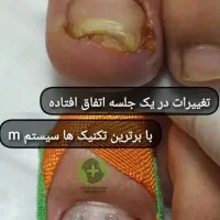 درمان ناخن فرورفته درگوشت بدون جراحی در کلینیک|خدمات آرایشگری و زیبایی|ورامین, خیر آباد|دیوار