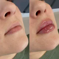 تخفیف لیزر موهای زائد تا آخر هفته  ۳۹۰ تومان|خدمات آرایشگری و زیبایی|کرج, گوهردشت|دیوار