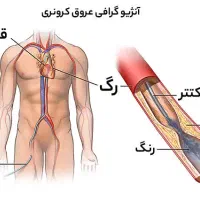 راهنمایی تجربه آنژیوگرافی
