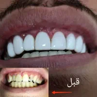 کامپوزیت اورجینال با ضمانت(تخفیف ویژه)