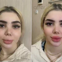 ژل بوتاکس کانتورینگ صورت آنزیم فیلر بینی مزوژل|خدمات آرایشگری و زیبایی|گرمسار, |دیوار