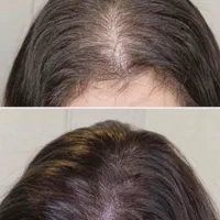 آفر20 درصد درمان قطعی ریزش مو و رویش بدون بازگشت|خدمات آرایشگری و زیبایی|مشهد, کوثر|دیوار