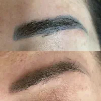 پاک تتو و رد بخیه کک ومک ولک