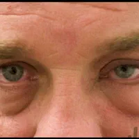 عمل زیبائی پلک و عمل رفع پف زیر چشم|خدمات آرایشگری و زیبایی|شاهینشهر, |دیوار