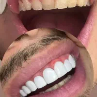 تخفیف ویژه کامپوزیت