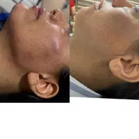 تزریق ژل سی سی 600|خدمات آرایشگری و زیبایی|پیشوا, |دیوار