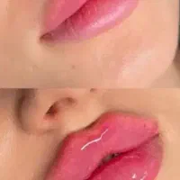 تزریق ژل وبوتاکس