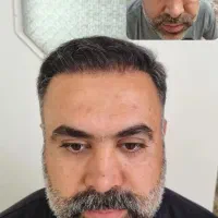 کاشت مو ابرو لیزر ژل بوتاکس مزو واکسن زگیل تناسلی|خدمات آرایشگری و زیبایی|اندیشه, اندیشه فاز ۱|دیوار