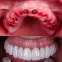 دندانپزشکی ،ایمپلنت، اوردنچر، روکش