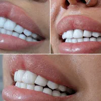 لابراتوار دندان،ساخت تخصصی روکش دندان