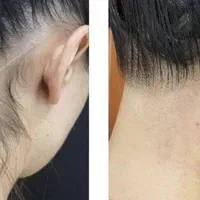 جشنواره 50% تخفیف ویژه مرکز لیزر الکس