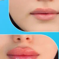 تزریق ژل وبوتاکس رایگان